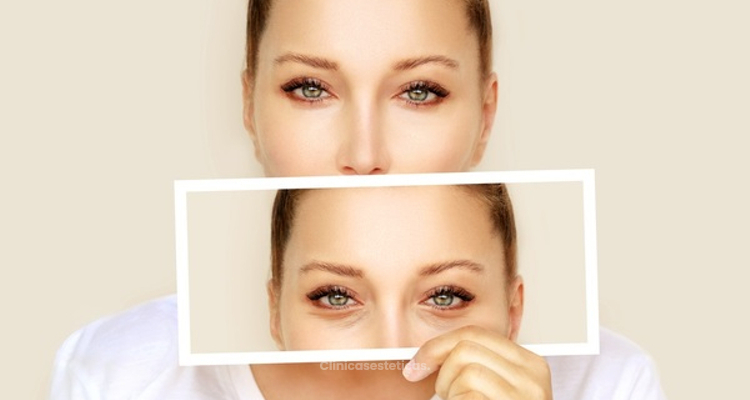 Lo que debe saber sobre la blefaroplastia