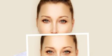 Lo que debe saber sobre la blefaroplastia