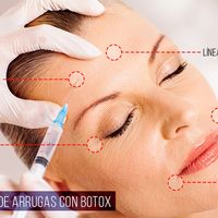 Todo lo que tienes que saber sobre el Botox