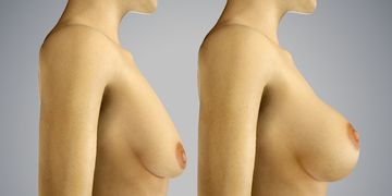 Mastopexia: el verdadero levantamiento de los senos