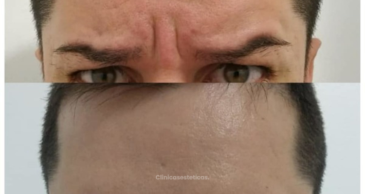 La Magia de la Tóxina Botulínica...(Botox)