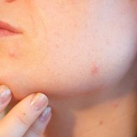 Todo lo que necesita saber sobre el acné
