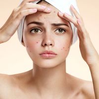 ¿Cómo puedo combatir el acné?