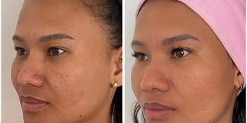 Radiesse: Rejuvenece tu rostro sin cirugía