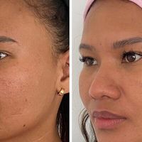 Radiesse: Rejuvenece tu rostro sin cirugía