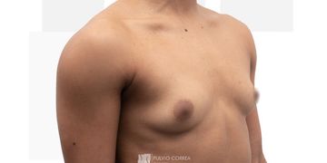 Técnicas quirúrgicas para realizar un aumento de senos ¿cúal es la mejor?