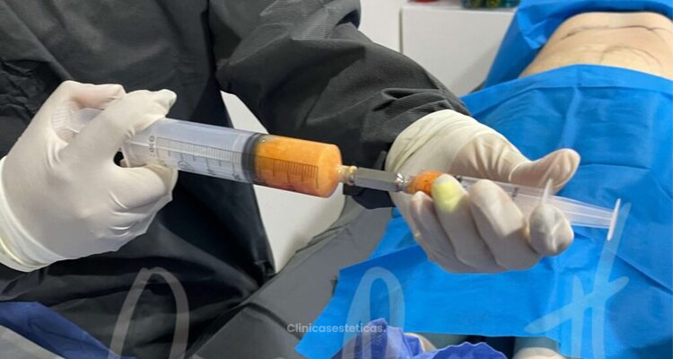 ¿Qué es el lipofilling?
