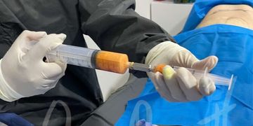¿Qué es el lipofilling?