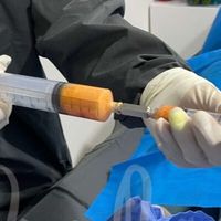 ¿Qué es el lipofilling?