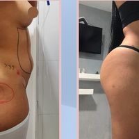 Prótesis de glúteos vs. Lipotransferencia: ¿Cuándo elegir cada opción?