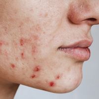 Mejores tratamientos para borrar cicatrices de acné