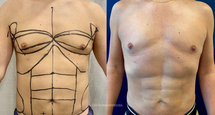 "Hay nuevas tecnologías que ayudan a mejorar los resultados de una liposucción"
