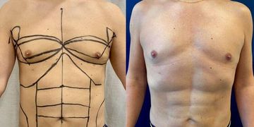 "Hay nuevas tecnologías que ayudan a mejorar los resultados de una liposucción" "Hay nuevas tecnologías que ayudan a mejorar los resultados de una liposucción"