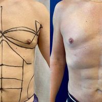 "Hay nuevas tecnologías que ayudan a mejorar los resultados de una liposucción"