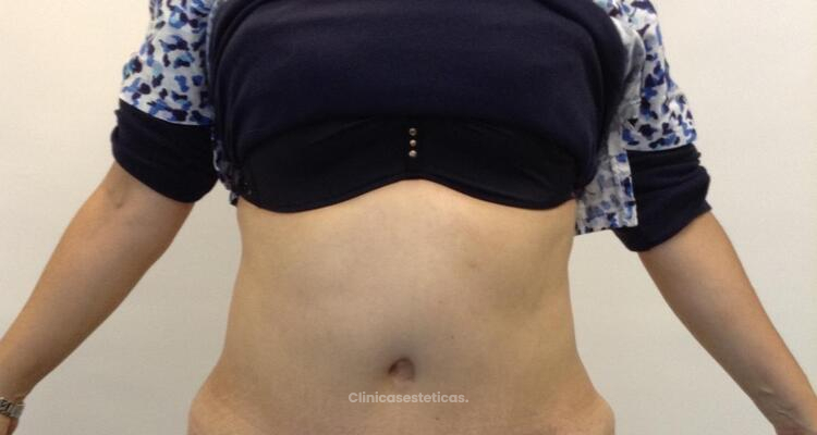 Complicaciones de abdominoplastia: cómo evitarlas