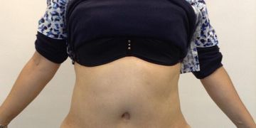 Complicaciones de abdominoplastia: cómo evitarlas Complicaciones de abdominoplastia: cómo evitarlas