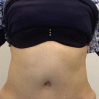 Complicaciones de abdominoplastia: cómo evitarlas