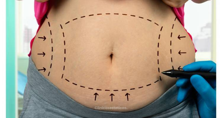 Abdominoplastia: Cuidados, precauciones y protocolos a seguir