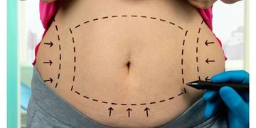 Abdominoplastia: Cuidados, precauciones y protocolos a seguir Abdominoplastia: Cuidados, precauciones y protocolos a seguir