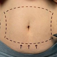 Abdominoplastia: Cuidados, precauciones y protocolos a seguir