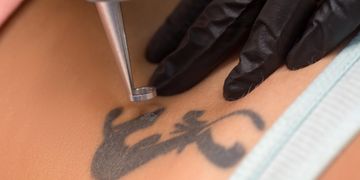 ¿Cuánto tarda en borrarse un tatuaje con láser?