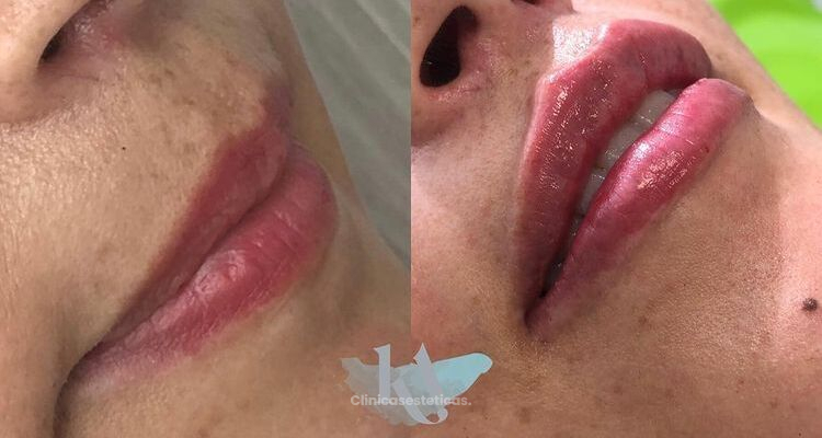 Fillers en labios: cómo lograr resultados naturales, seguros y armónicos