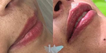 Fillers en labios: cómo lograr resultados naturales, seguros y armónicos