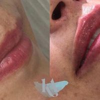Fillers en labios: cómo lograr resultados naturales, seguros y armónicos