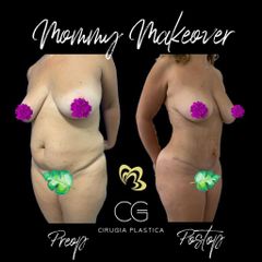 Mommy makeover - Dra. Catalina Guzman Duque