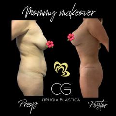 Mommy makeover - Dra. Catalina Guzman Duque