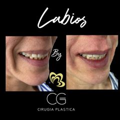 Aumento de labios - Dra. Catalina Guzman Duque