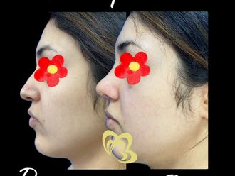 Rinoplastia antes y después - 829454