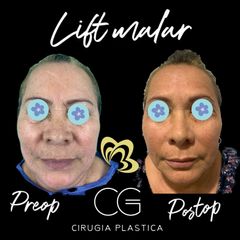 Lifting Facial - Dra. Catalina Guzman Duque