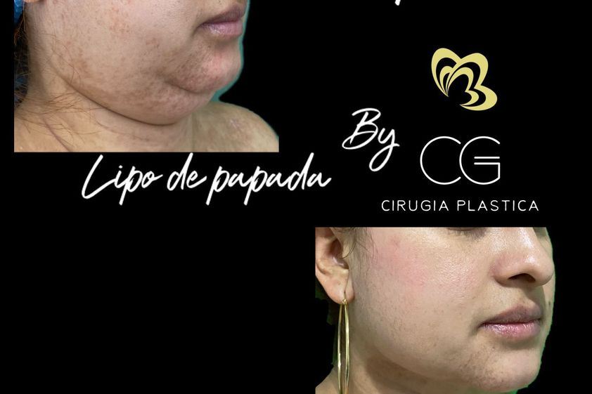 Cirugía de papada antes y después - 829456