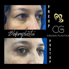 Blefaroplastia - Dra. Catalina Guzman Duque