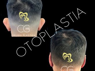 Otoplastia antes y después - 870827