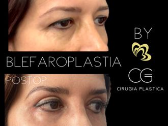 Blefaroplastia antes y después - 870828