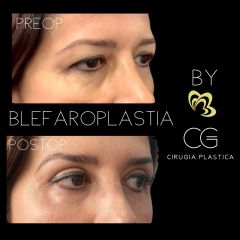 Blefaroplastia - Dra. Catalina Guzman Duque