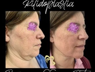 Lifting facial antes y después - 870830