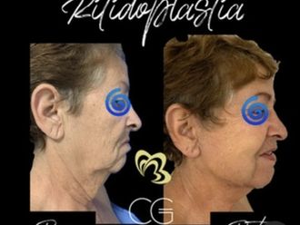 Lifting facial antes y después - 870831