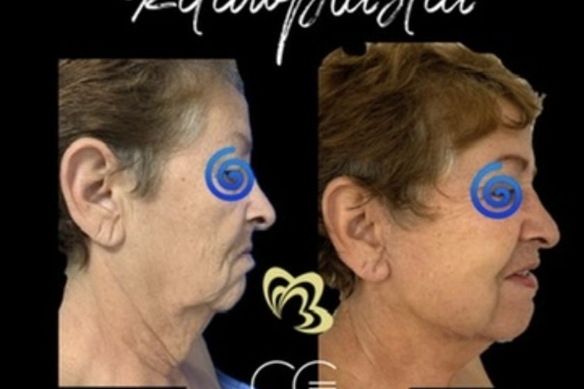 Lifting facial antes y después - 870831