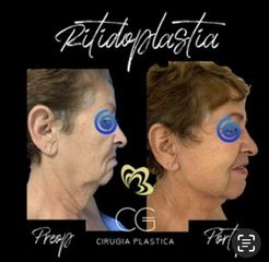 REJUVENECIMIENTO FACIAL QUIRÚRGICO - Dra. Catalina Guzman Duque