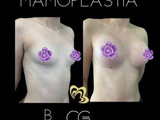 Mamoplastia de aumento antes y después - 870835