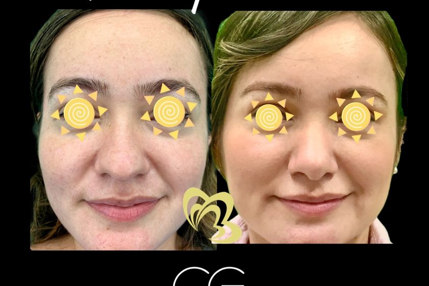 Rinoplastia antes y después - 870836