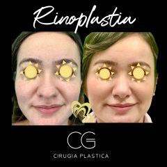 Rinoplastia - Dra. Catalina Guzman Duque