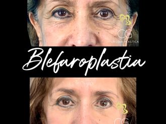 Blefaroplastia antes y después - 870838