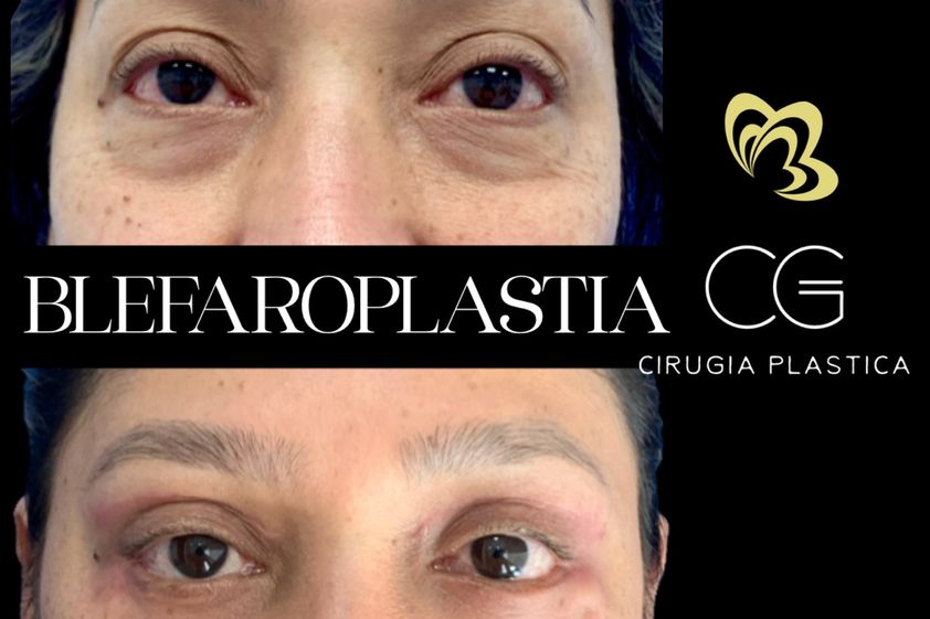 Blefaroplastia antes y después - 870839