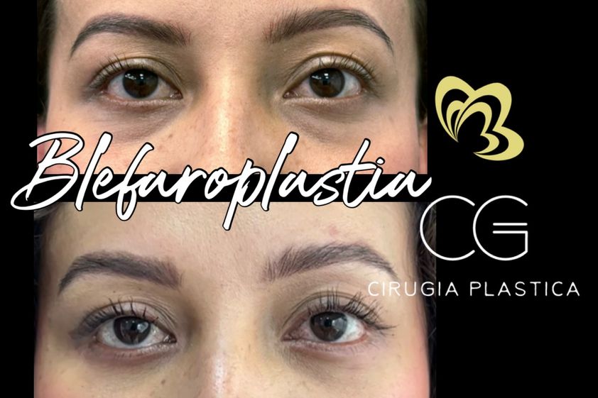 Blefaroplastia antes y después - 870841