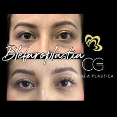 CIRUGIA PARA OJERAS - Dra. Catalina Guzman Duque