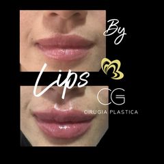 AUMENTO DEL VOLUMEN DE LOS LABIOS